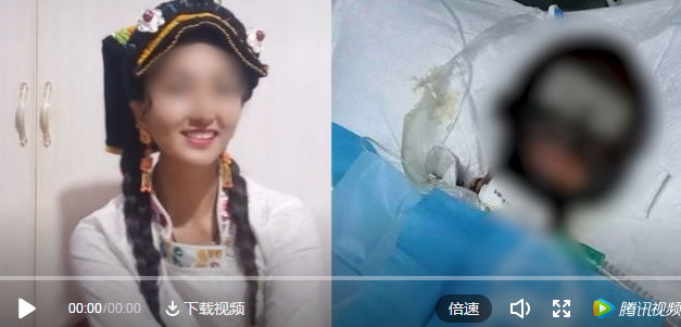 太惨烈!网红"拉姆"遭前夫纵火焚烧3小时,全身烧伤85%